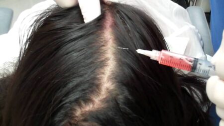 الفيلر هل هو بديل لزراعة الشعر