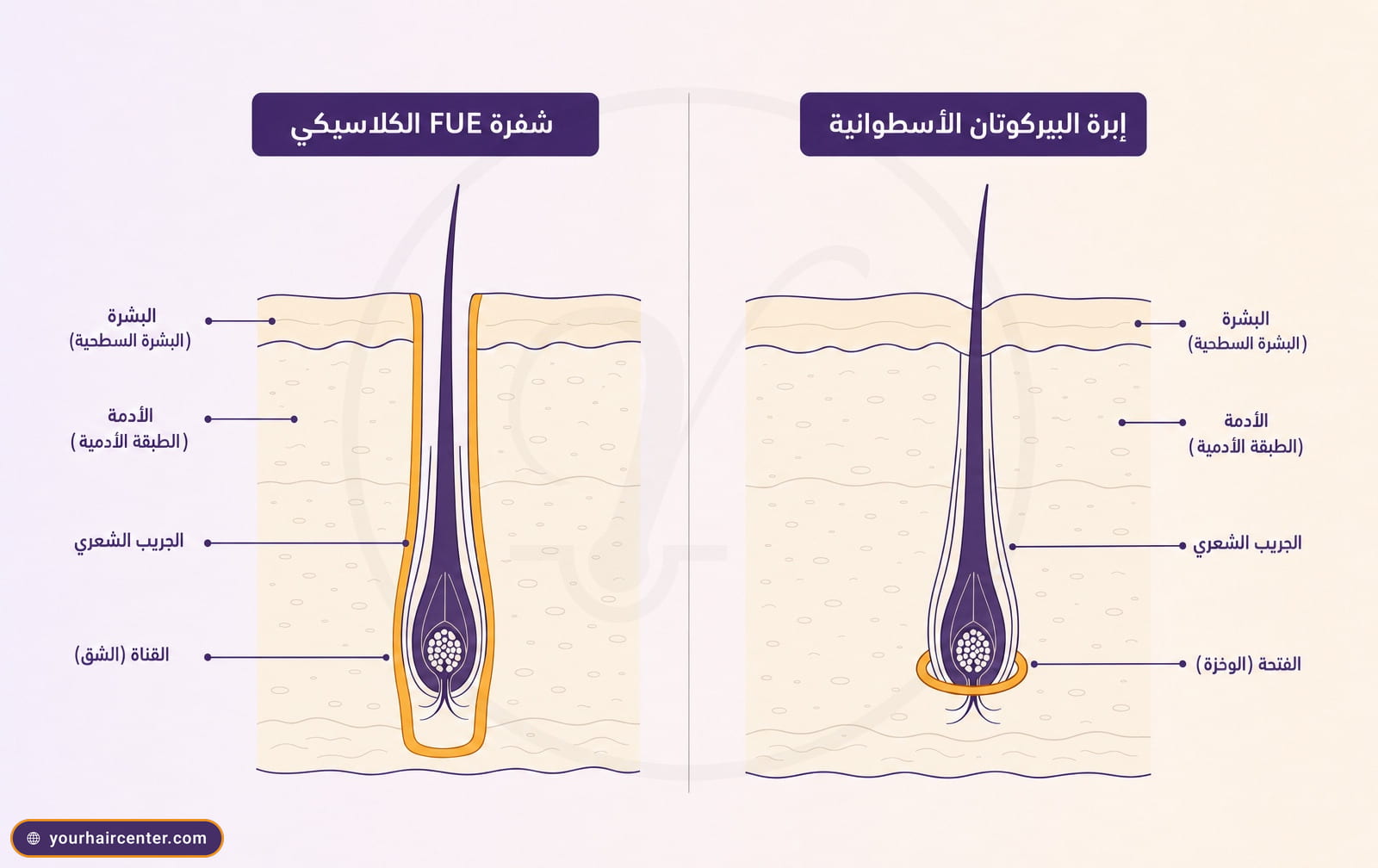 رسم تشريحي مقارن لمقطع فروة الرأس بين قناة شفرة FUE الكلاسيكي الطويلة وفتحة إبرة البيركوتان الأسطوانية الضيقة حول البصيلة