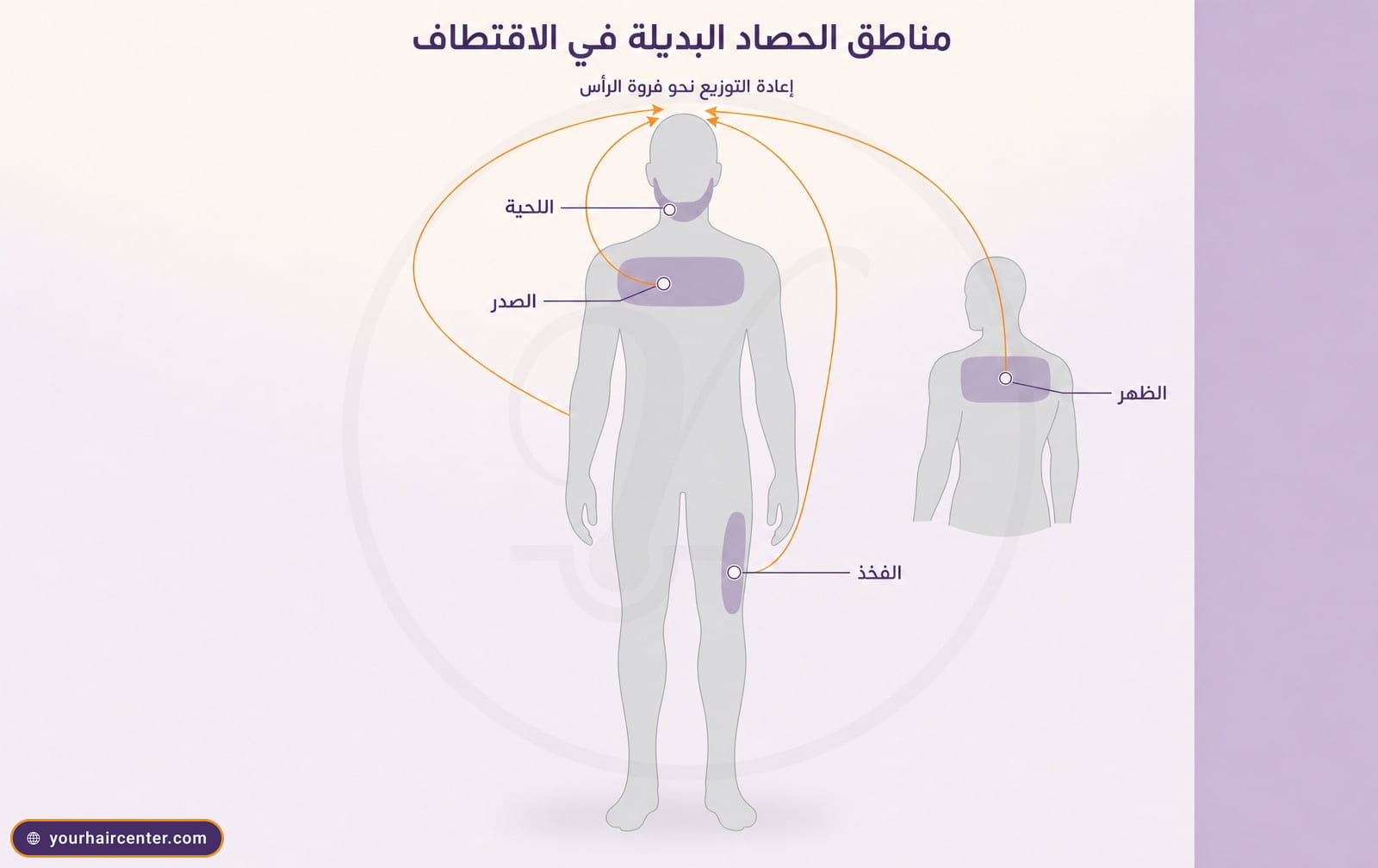 رسم تشريحي لمناطق حصاد البصيلات البديلة في الاقتطاف، اللحية والصدر والظهر والفخذ، مع أسهم إعادة توزيع نحو فروة الرأس
