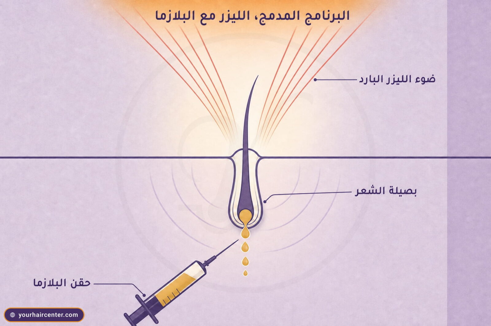 رسم تخطيطي للبرنامج المدمج، بصيلة شعر في المنتصف يصلها ضوء الليزر البارد من الأعلى وقطرات بلازما ذهبية من سرنجة في الأسفل