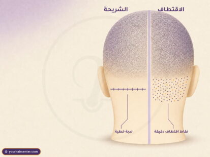 مقارنة تخطيطية لمؤخرة الرأس توضح الفرق بين FUE والشريحة، ندبة خطية على يسار الجمجمة ونقاط اقتطاف دقيقة على اليمين