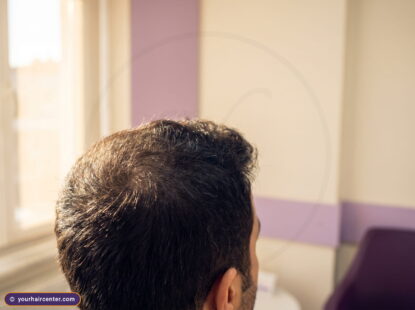 فروة رأس رجل بكثافة شعر طبيعية كاملة بعد زراعة الشعر بالبيركوتان دون ندبات أو احمرار في إضاءة إسطنبول الدافئة