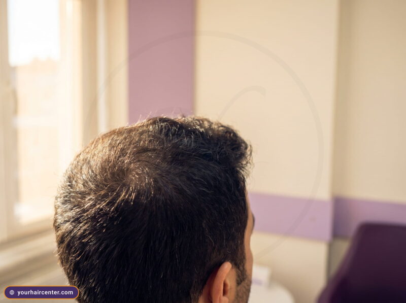 فروة رأس رجل بكثافة شعر طبيعية كاملة بعد زراعة الشعر بالبيركوتان دون ندبات أو احمرار في إضاءة إسطنبول الدافئة