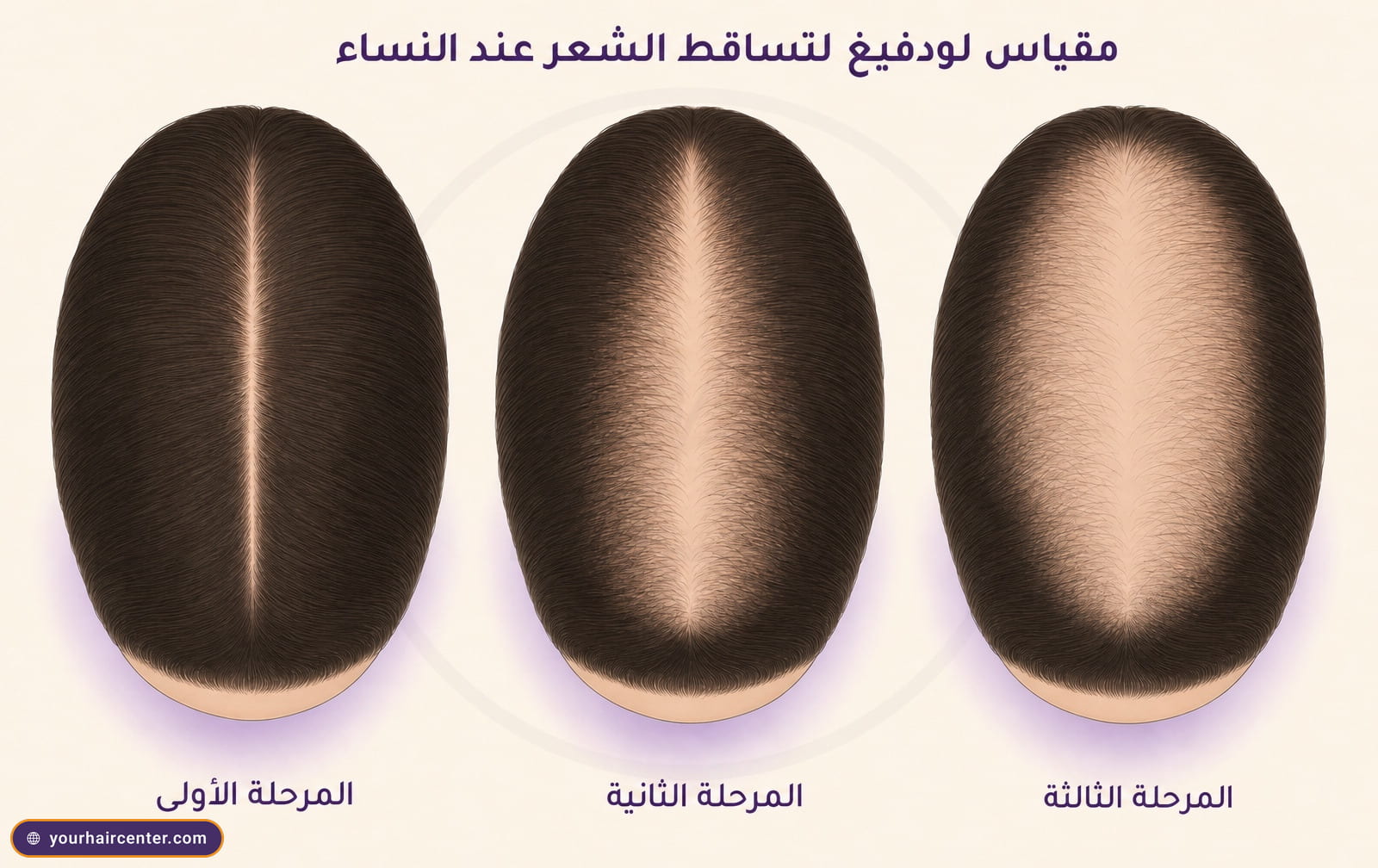 ثلاث صور علوية لفروة رأس أنثوية توضح تطور مقياس لودفيغ من اتساع المفرق إلى ترقق التاج مع بقاء خط الجبهة سليماً