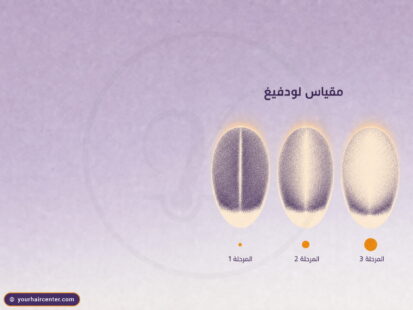 ثلاث رؤوس بيضاوية مجردة تقارن مراحل لودفيج للصلع الوراثي عند النساء من خط فرق ضيق إلى ترقق شديد في التاج