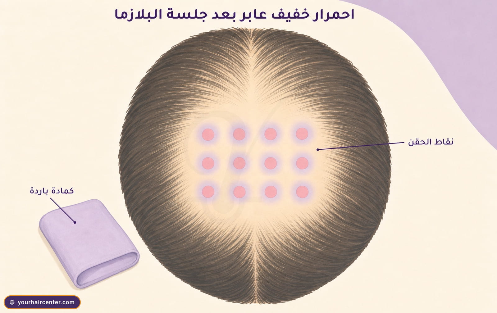 رسم توضيحي لاثنتي عشرة نقطة وردية على فروة الرأس تمثل احمرارًا خفيفًا عابرًا بعد جلسة البلازما مع كمادة باردة بنفسجية