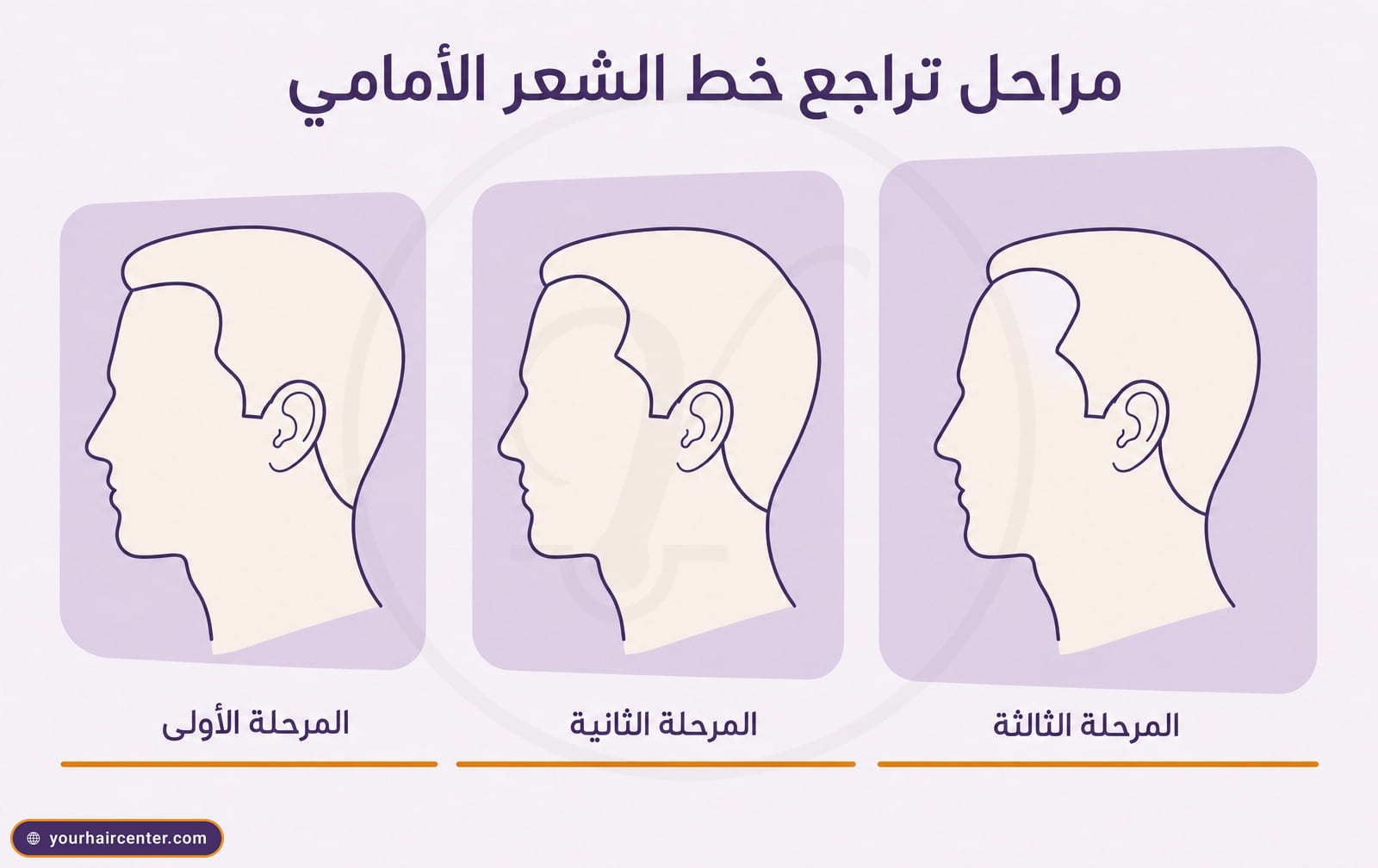 مخطط مراحل نورود الثلاث الأولى لتراجع خط الشعر الأمامي عند الصدغين والجبهة بأسلوب رسمي بنفسجي وكريمي