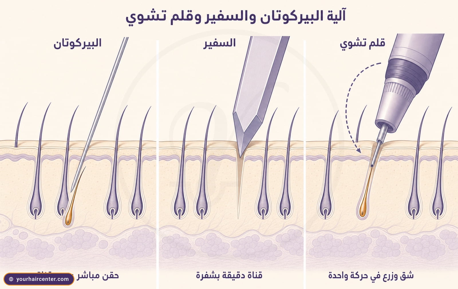 رسم تشريحي ثلاث لوحات لمقطع فروة الرأس يقارن إبرة البيركوتان بدون قناة وشفرة السفير الياقوتية وقلم تشوي بحركة مشتركة