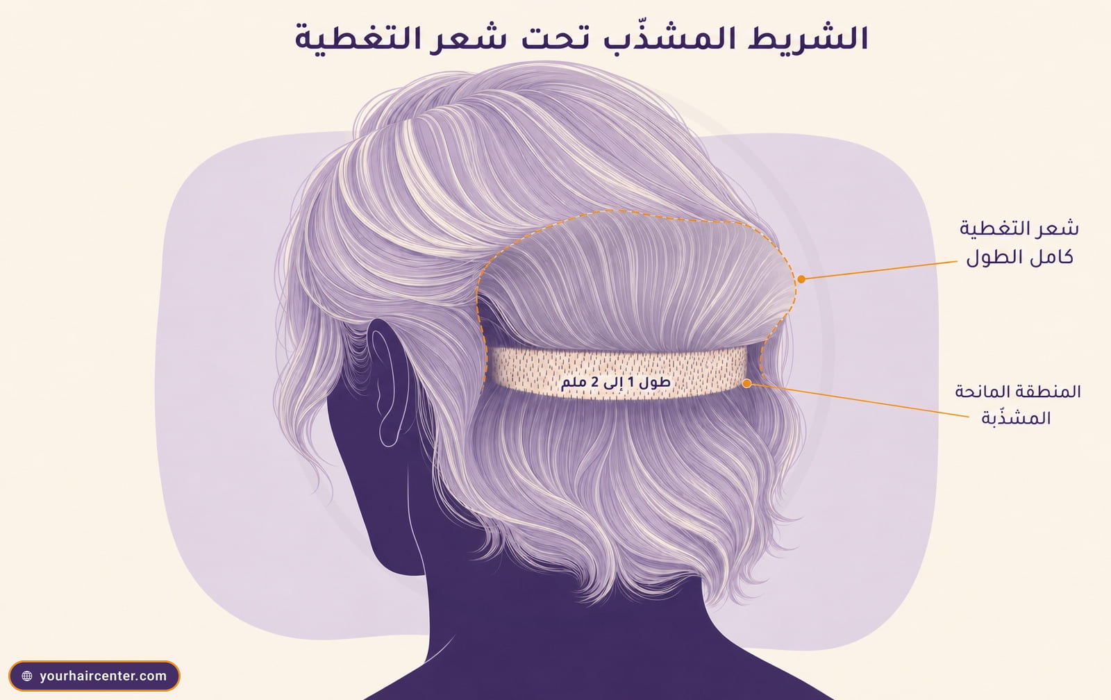 مخطط تشريحي لمؤخرة رأس بشعر علوي كامل الطول مرفوع جزئيًا ليكشف شريطًا ضيقًا مشذبًا بطول 1 إلى 2 ملم في المنطقة المانحة