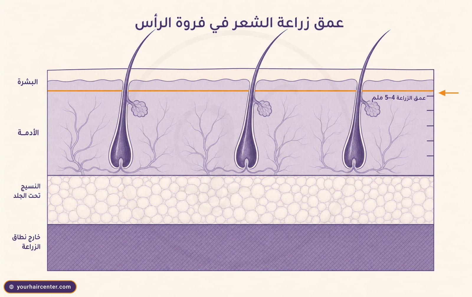 مقطع تشريحي لفروة الرأس بثلاث طبقات يوضح أن عمق زراعة الشعر 4 إلى 5 ملم فقط في الأدمة، خط برتقالي يحدد عمق الإجراء