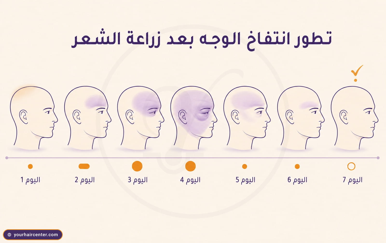 إنفوجرافيك بسبع رؤوس جانبية متتالية من اليوم 1 إلى اليوم 7 يوضح تطور انتفاخ الوجه بعد زراعة الشعر بلون لافندر يصعد حتى اليوم الرابع ثم يتراجع