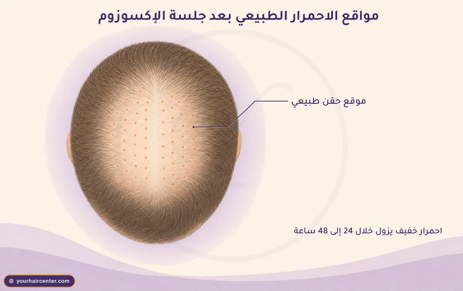 رسم توضيحي علوي لفروة رأس بعد جلسة اكسوزوم تظهر فيه نقاط حمراء خفيفة في موقع الحقن مع تعليق عربي يوضح أن الاحمرار يزول خلال 24 إلى 48 ساعة