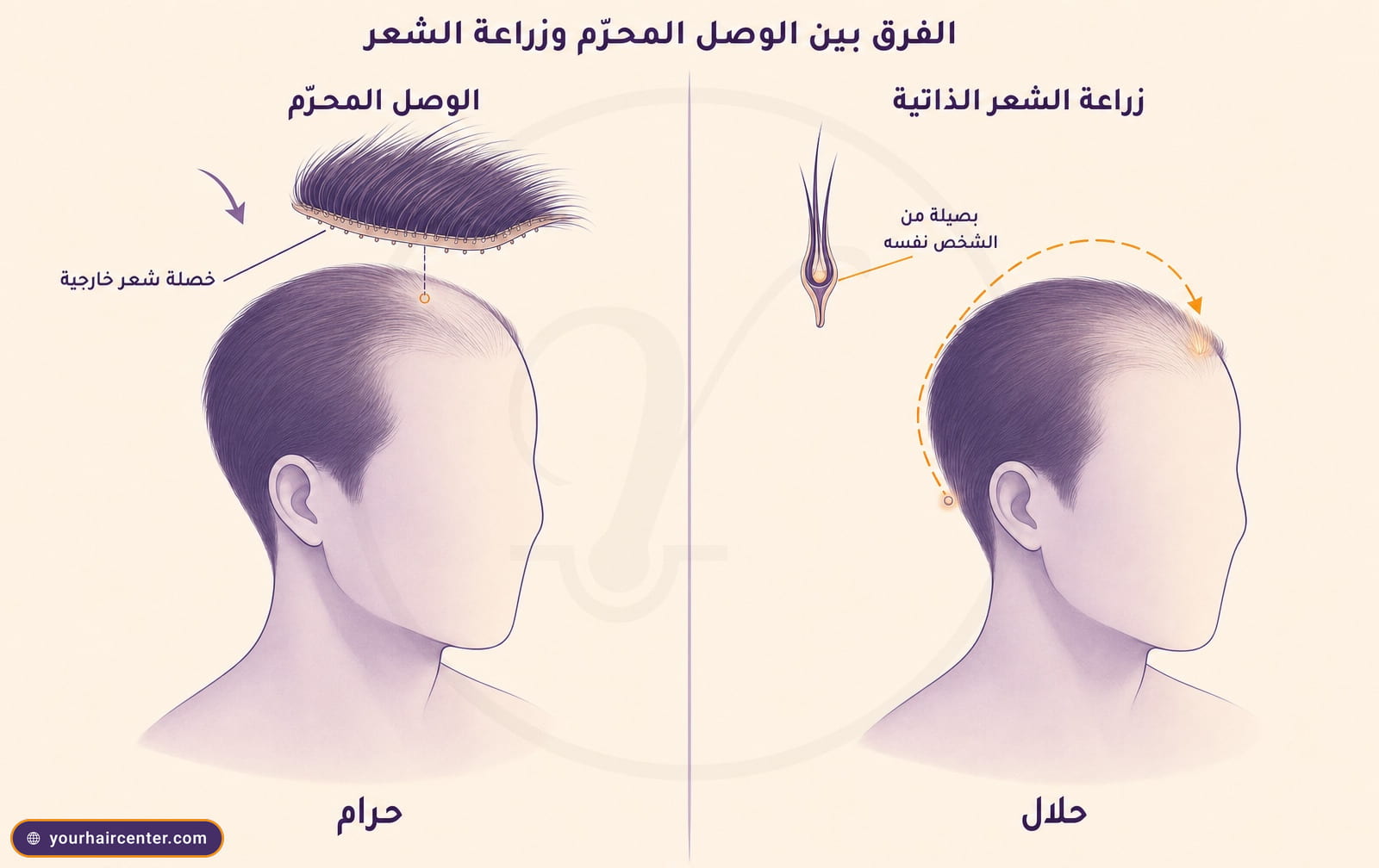 رسم مفاهيمي بلوحتين، يسار رأس عليه خصلة شعر خارجية مضافة موسومة حرام، يمين رأس تنقل بصيلة ذاتية من الخلف إلى المقدمة موسومة حلال