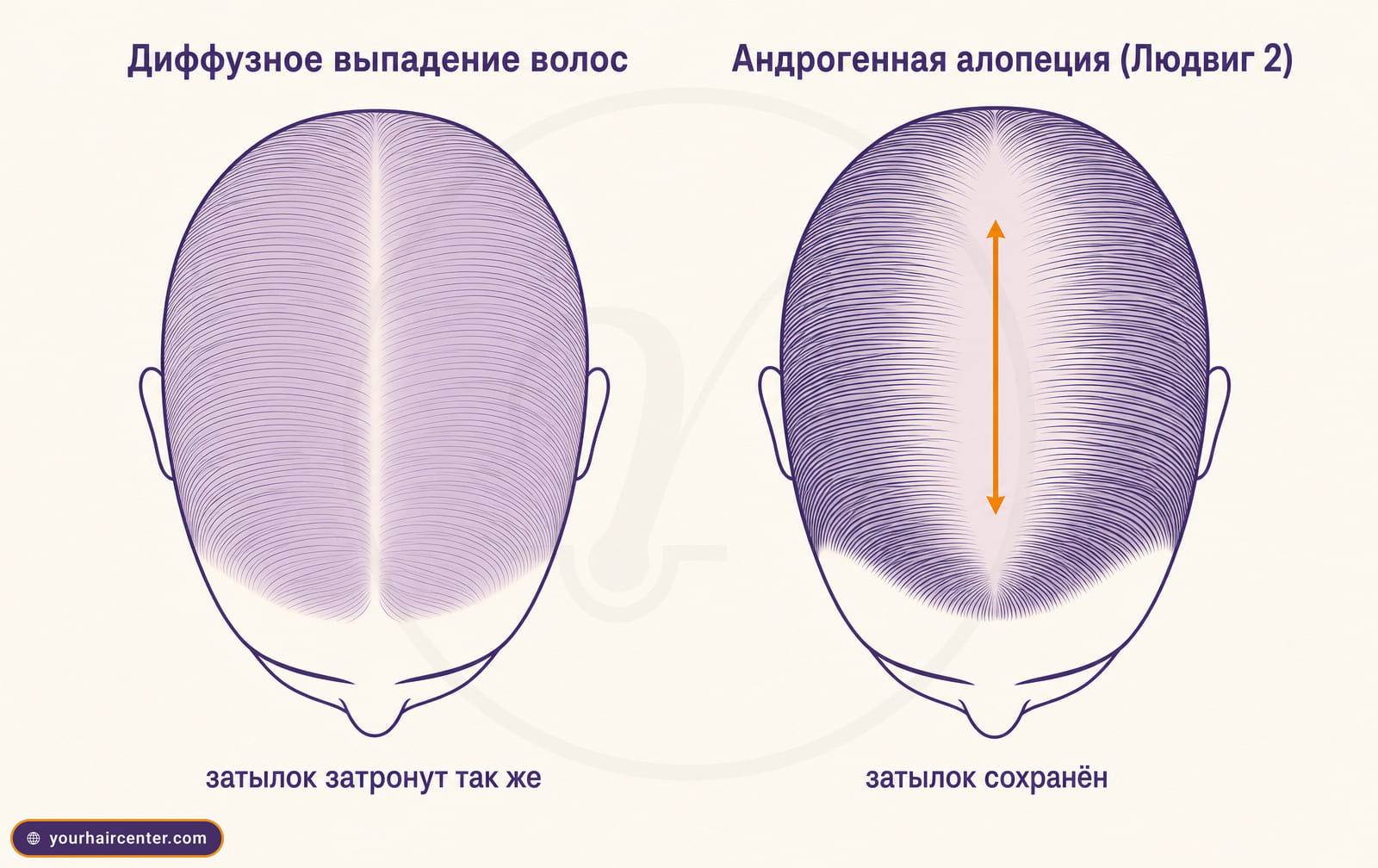 Сравнительная схема диффузного выпадения волос и андрогенной алопеции на двух видах кожи головы сверху