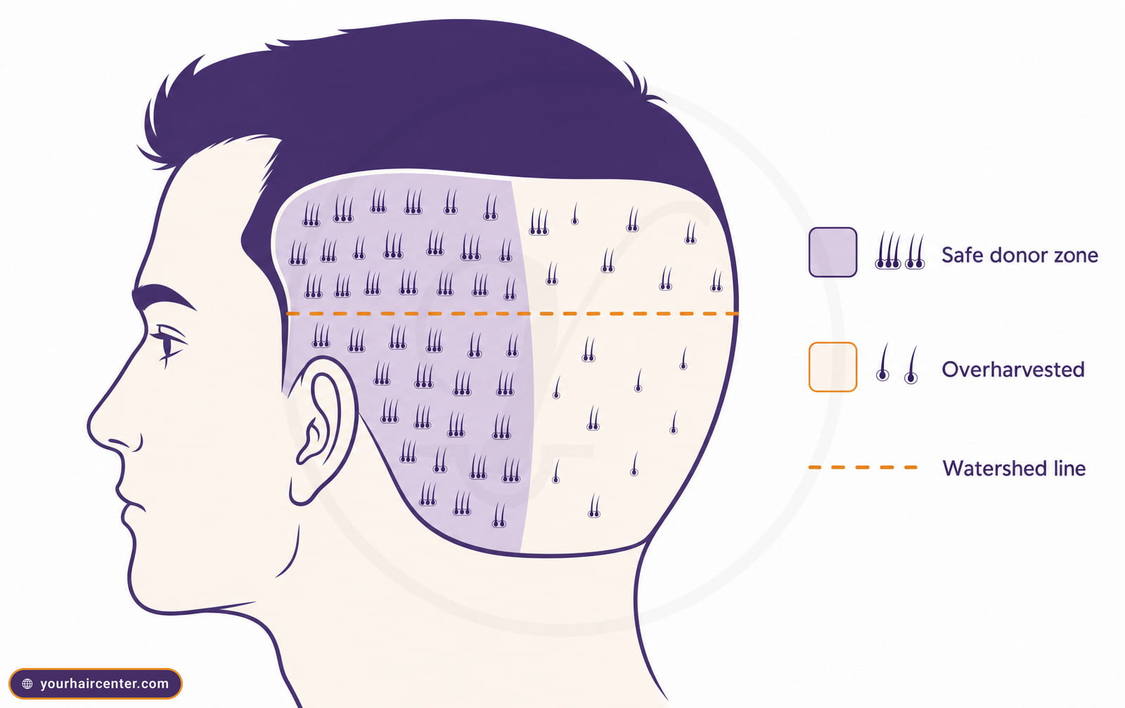 Diagram of the FUE donor safe zone versus an overharvested area, with follicular-unit spacing and a dashed watershed line