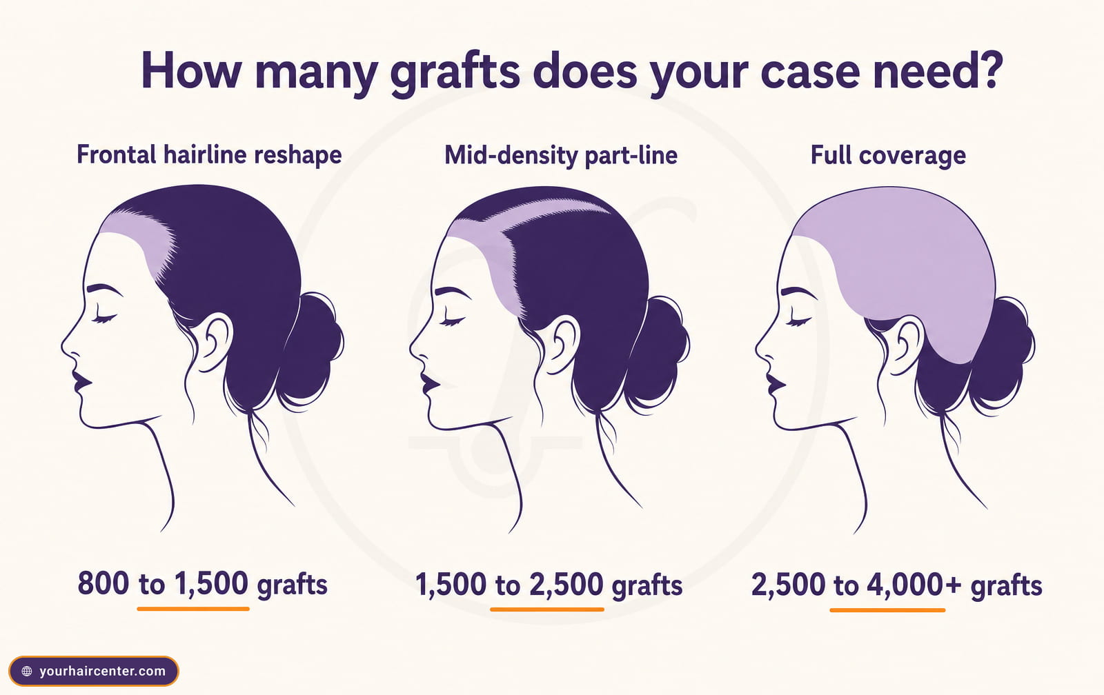 Graft-count bands for female hair transplant: frontal hairline reshape 800 to 1,500 grafts, mid-density part-line 1,500 to 2,500, full coverage 2,500 to 4,000+