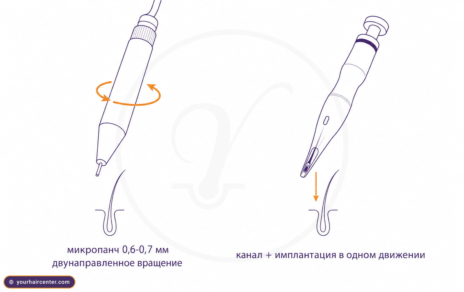 Схема FUE или DHI для кудрявых волос, микропанч с вращением слева и ручка Choi с графтом справа над изогнутым фолликулом