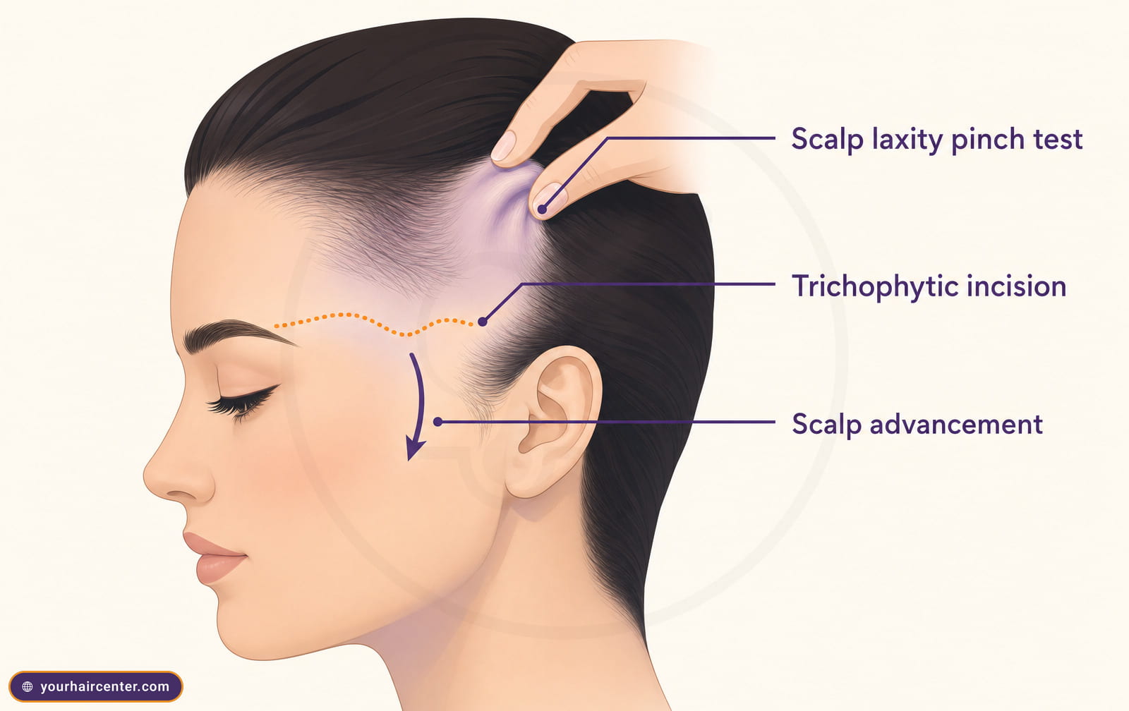 Hairline lowering surgery: side-profile diagram showing scalp laxity pinch test, trichophytic incision, and scalp advancement