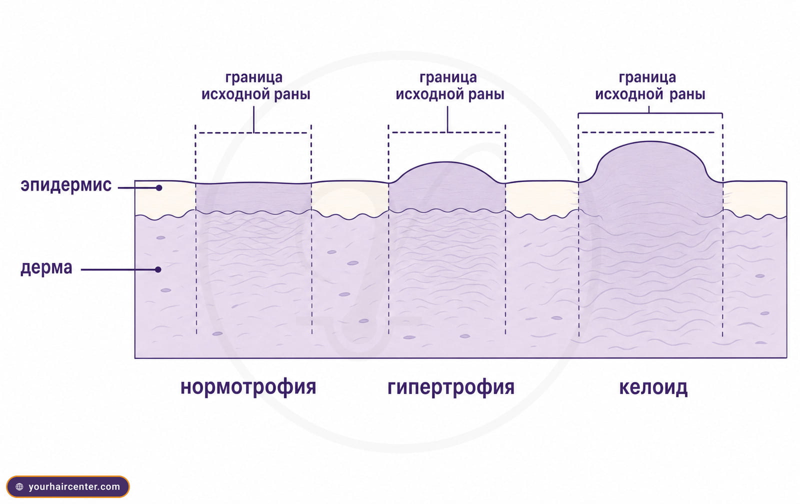 Диаграмма поперечного среза кожи: нормотрофия, гипертрофия и келоид относительно границы исходной раны.