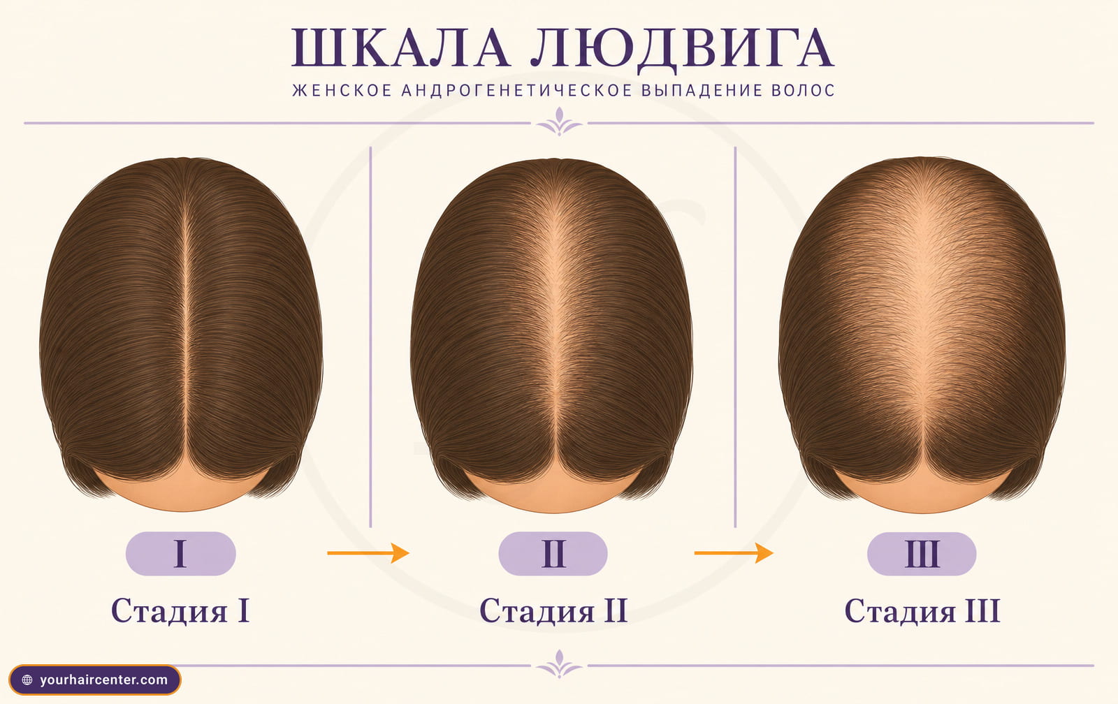 Шкала Людвига I, II, III, вид макушки сверху с постепенным расширением пробора при женском облысении