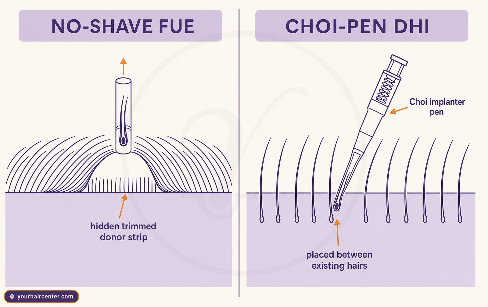 Diagram comparing No-Shave FUE donor trimming under the hair canopy with Choi-pen DHI placement between existing hairs