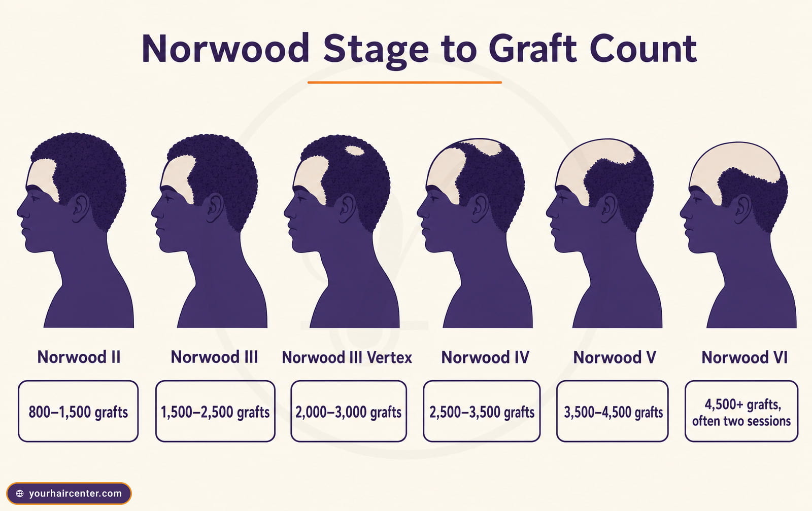 Norwood scale stages II to VI for Black male hair loss paired with the typical graft-count band per stage