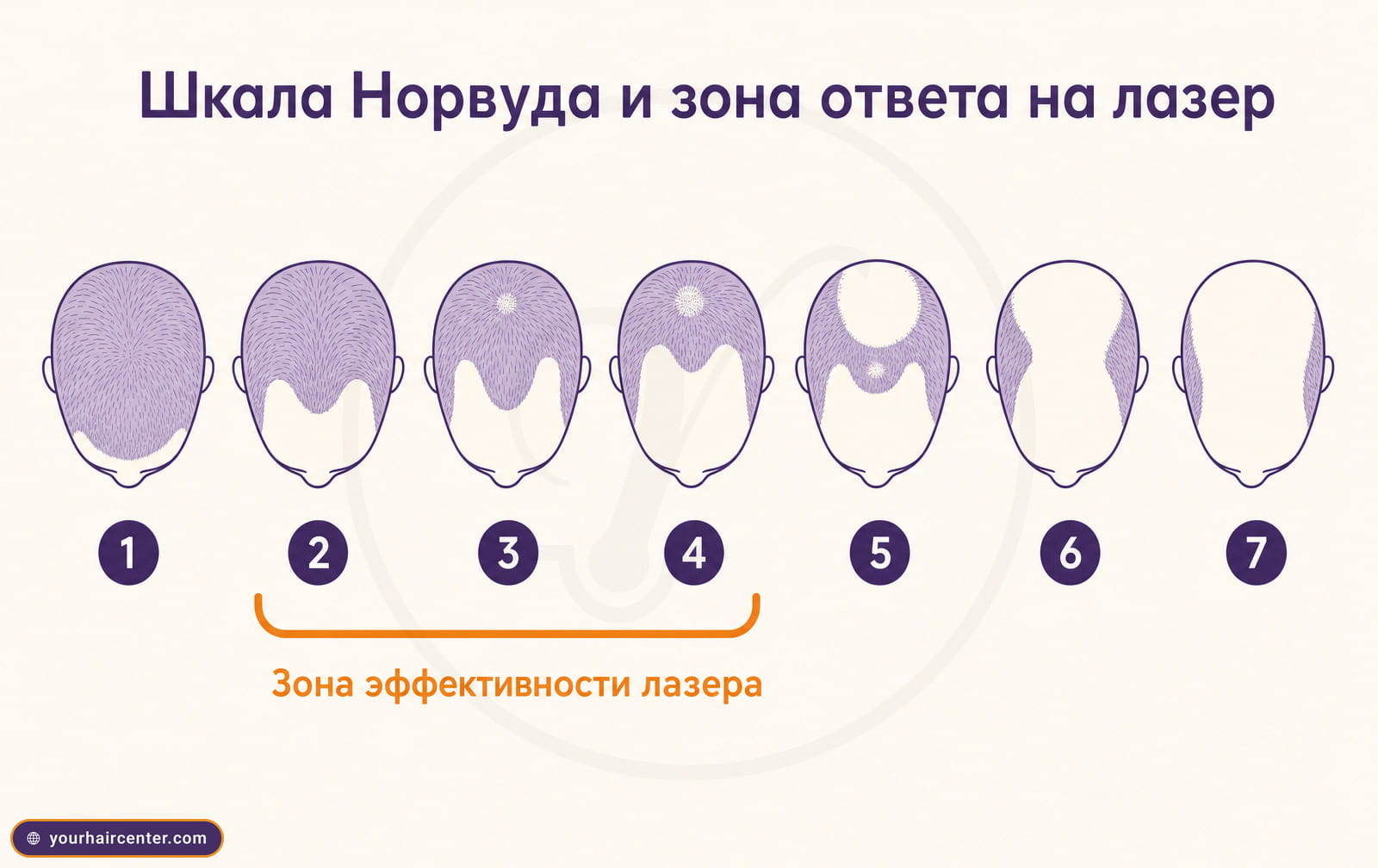 Шкала Норвуда от стадии 1 до 7 с выделенными стадиями 2, 3 и 4 как зоной эффективности лазера