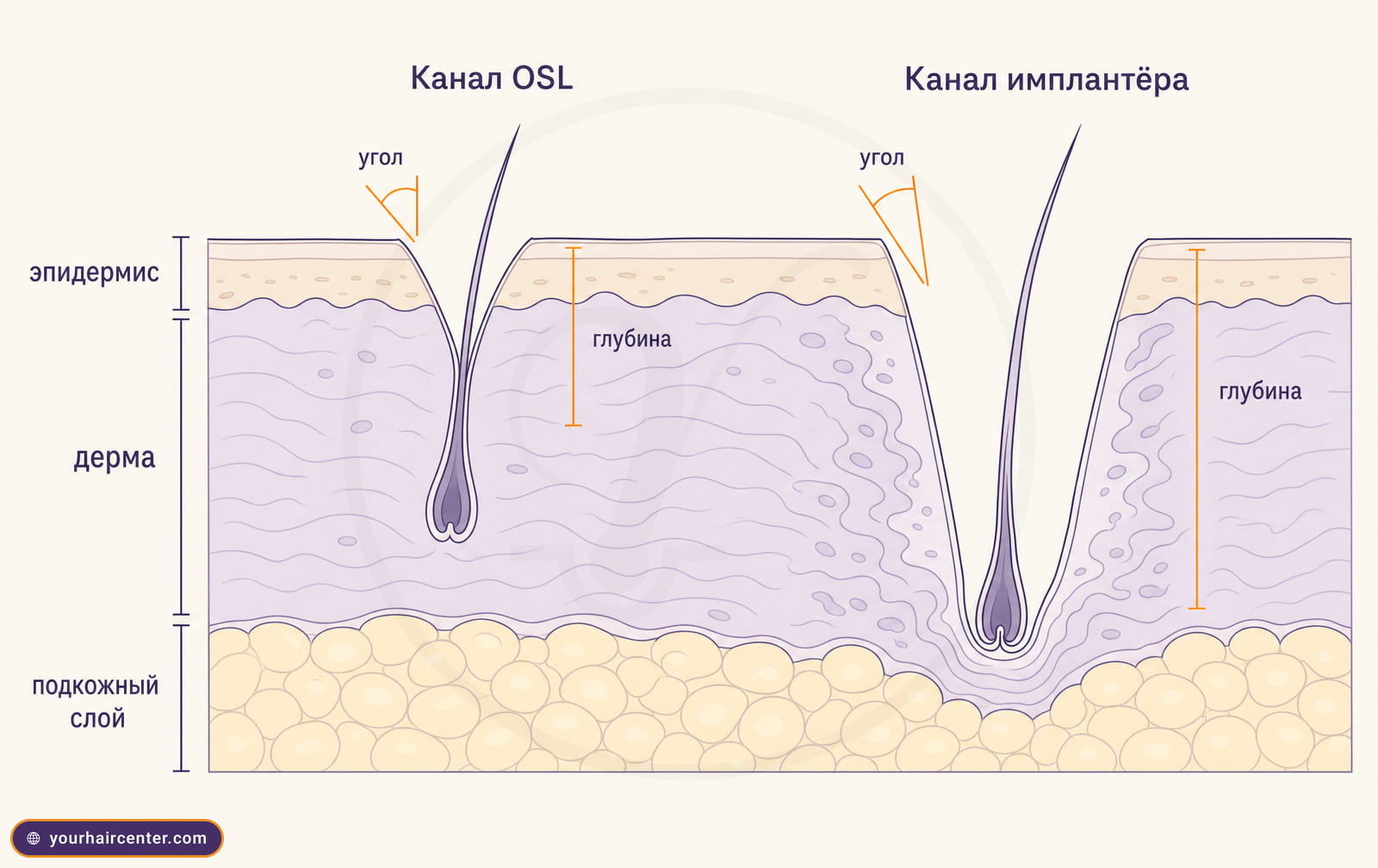 Инфографика в разрезе кожи лица, узкий неглубокий канал OSL слева и более широкий глубокий канал имплантёра справа