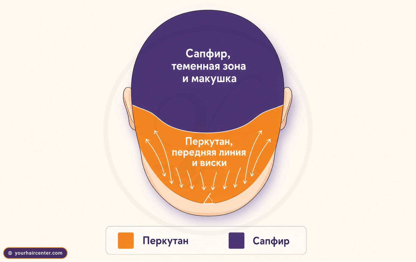 Схема скальпа сверху, оранжевая перкутан-зона на передней линии и висках, фиолетовая сапфир-зона на темени и макушке