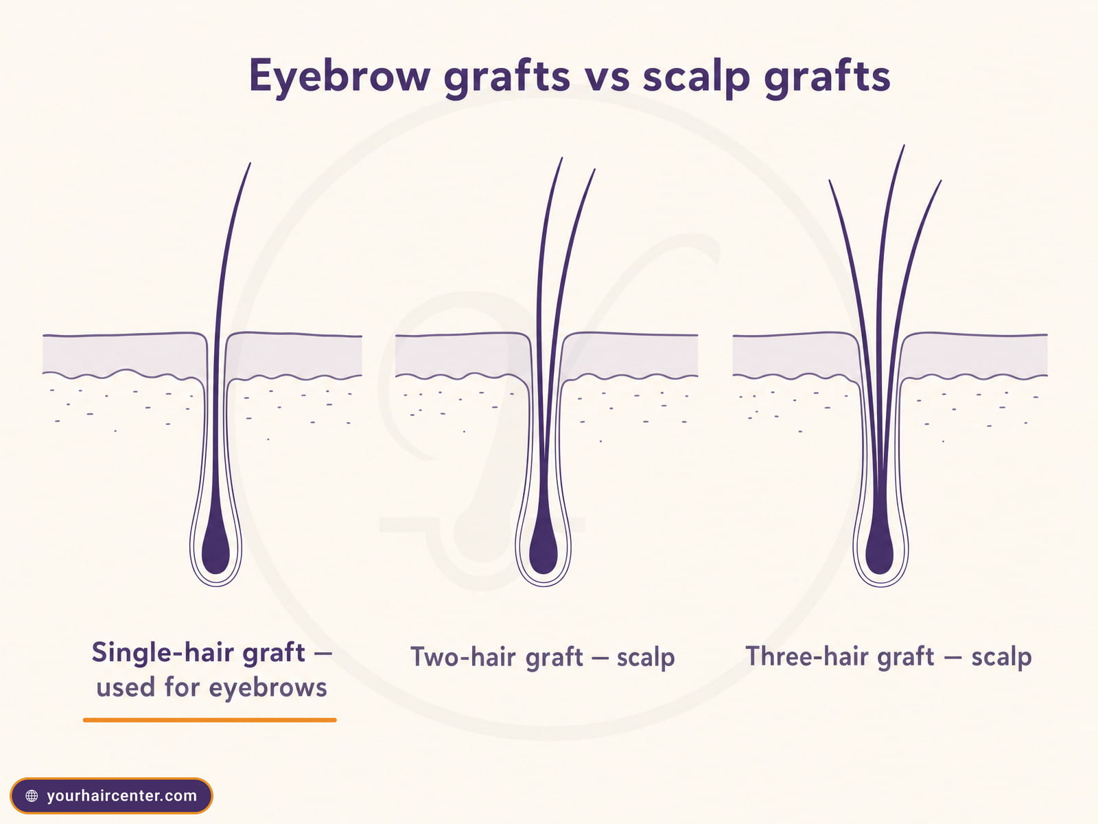 Diagram comparing a single-hair follicular unit graft for eyebrows with two-hair and three-hair scalp grafts