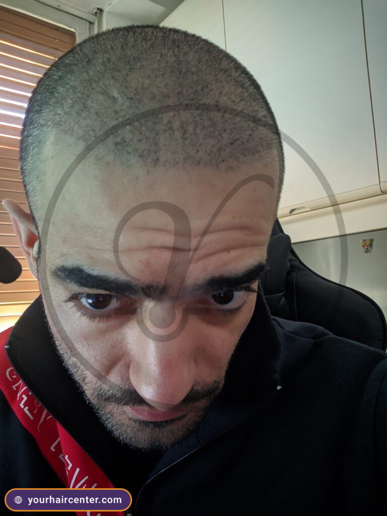 Hair transplant case YHC-0013, after result