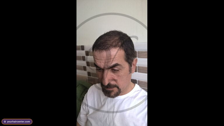 Hair transplant case YHC-0019 — after result