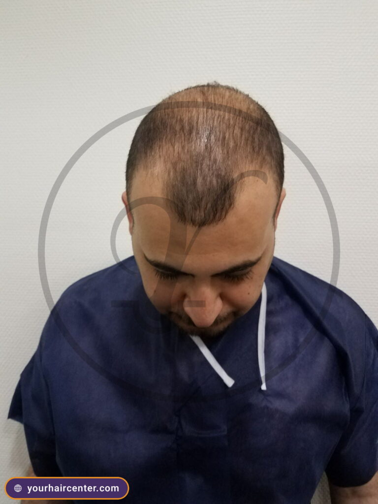Hair transplant case YHC-0033 — before