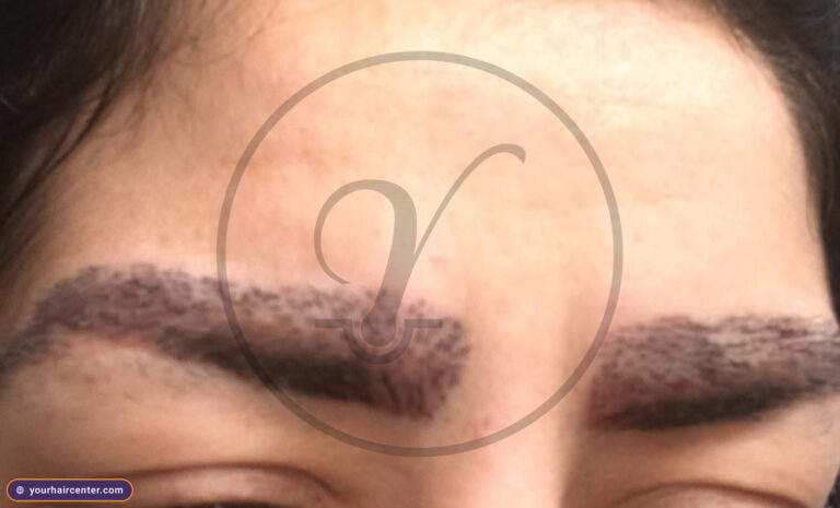 Eyebrow transplant case YHC-0044 — before