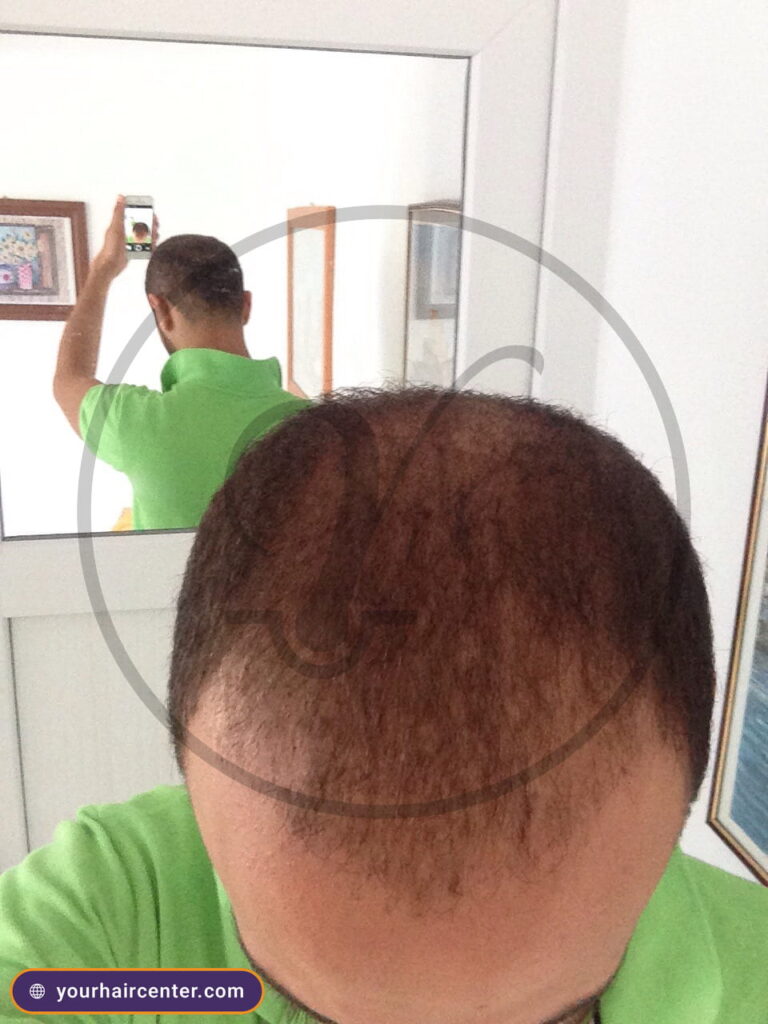 Hair transplant case YHC-0048 — before