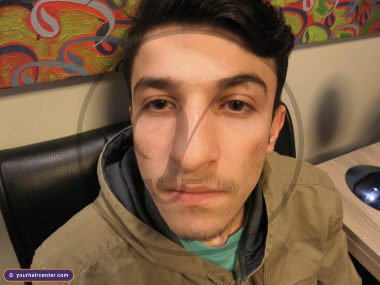 Beard transplant case YHC-0050 — before