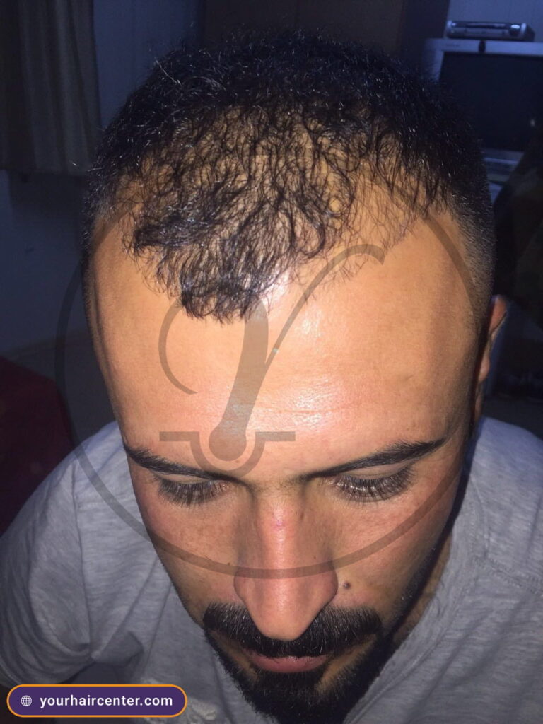 Hair transplant case YHC-0051 — before