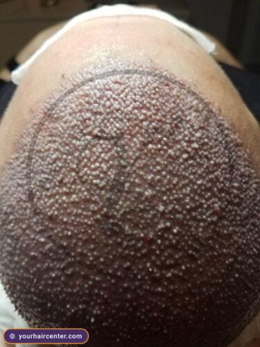 Hair transplant case YHC-0062 — follow-up result