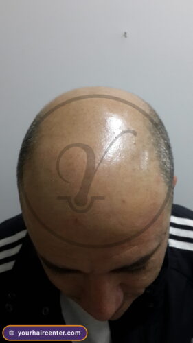 Hair transplant case YHC-0071 — pre-op