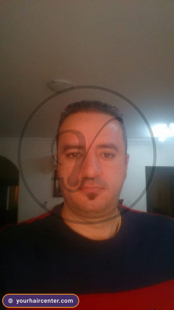 Hair transplant case YHC-0071 — after result