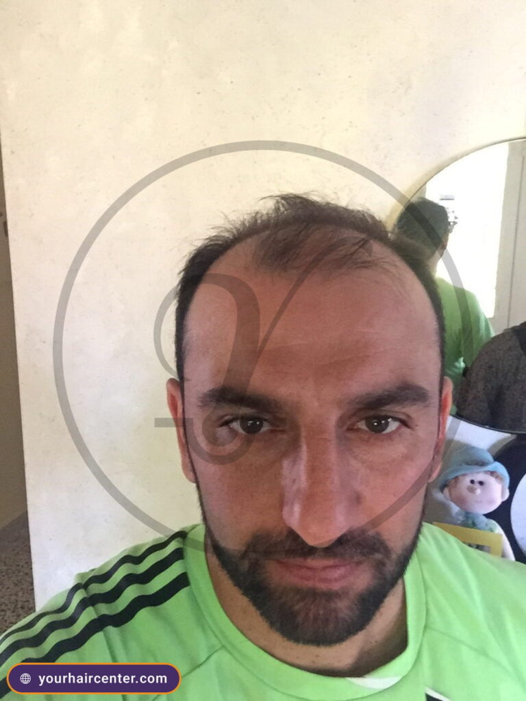 Hair transplant case YHC-0072 — before