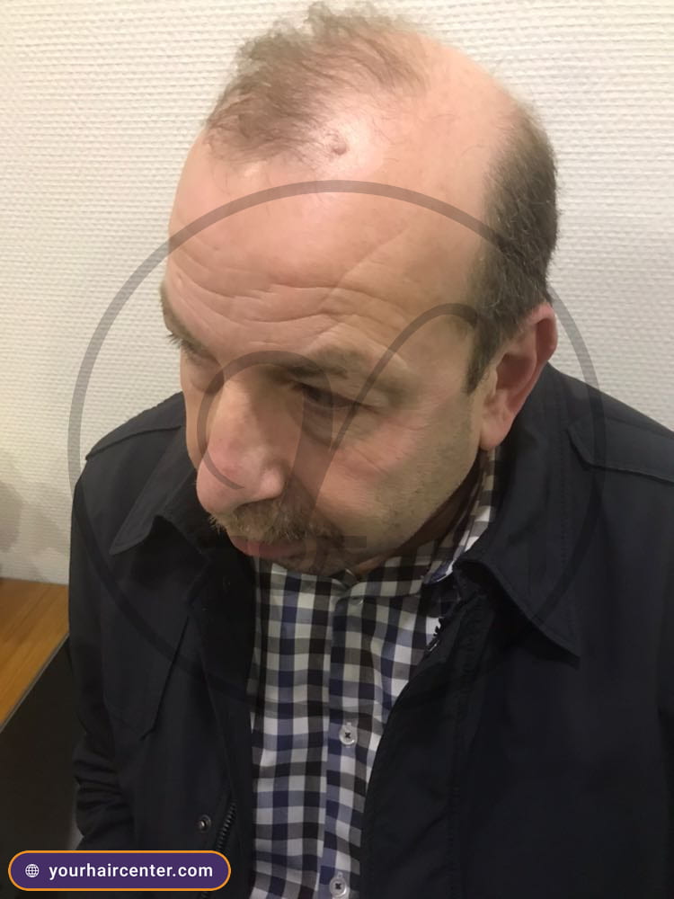 Hair transplant case YHC-0075 — before