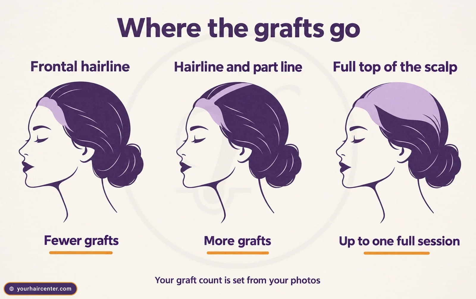 Three female head profiles marking where the grafts go, the frontal hairline with fewer grafts, the hairline and part line with more, and the full top of the scalp up to one full session