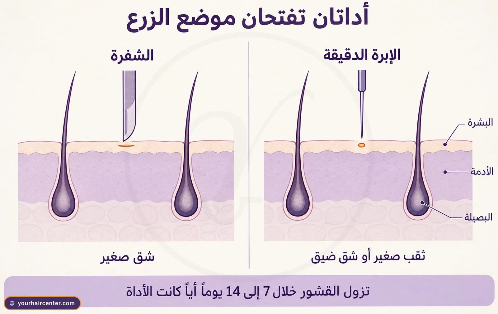 رسم مقطعي لفروة الرأس يقارن شقاً صغيراً تفتحه الشفرة بثقب صغير تفتحه إبرة البيركوتان الدقيقة لموضع الزرع