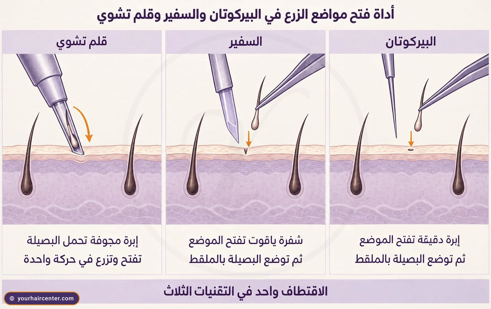 رسم بثلاث لوحات لمقطع فروة الرأس يقارن إبرة البيركوتان الدقيقة وشفرة السفير اللتين تفتحان الموضع ثم توضع البصيلة بالملقط، وقلم تشوي الذي يفتح ويزرع في حركة واحدة