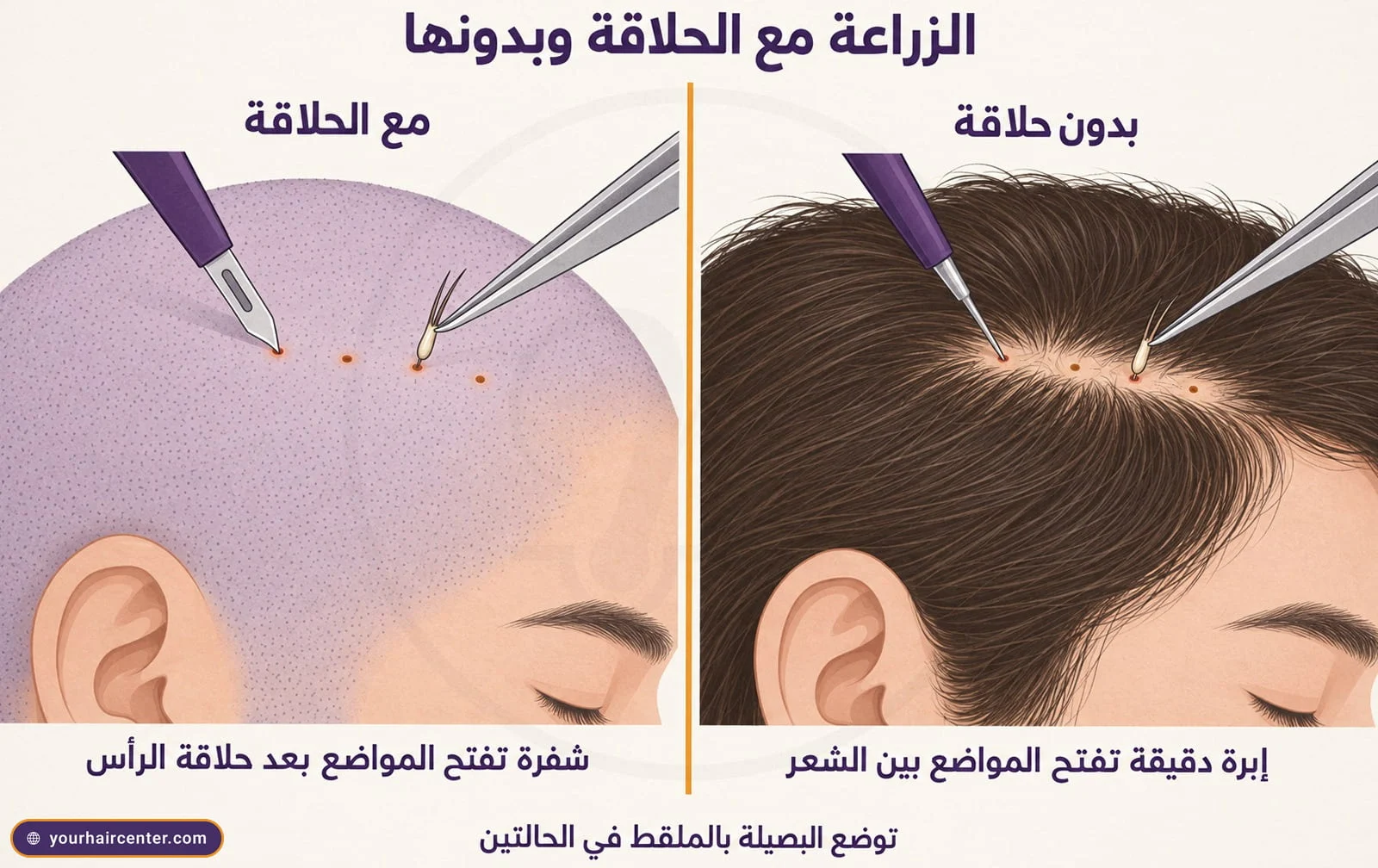 لوحتان متجاورتان، فروة محلوقة تفتح فيها شفرة مواضع الزرع وشعر طويل قائم تفتح بينه إبرة دقيقة مواضع الزرع، وملقط يضع البصيلة في الحالتين